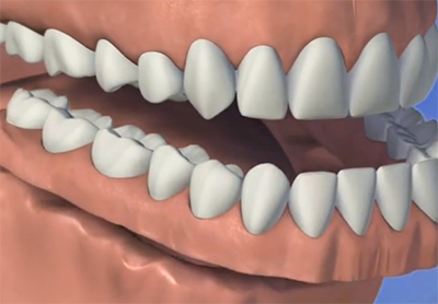 Dentures Dentures