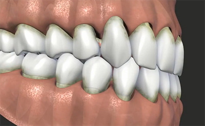 Periodontal Disease