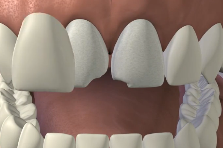 Porcelain Veneers Porcelain Veneers