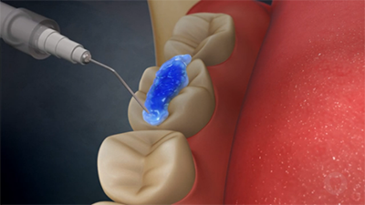 Dental Sealants Dental Sealants